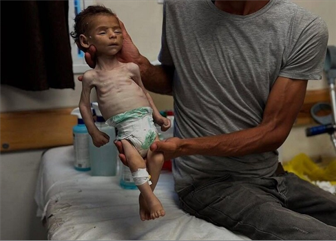 الصحة العالمية: الجوع الجماعي في غزة سببه الحصار الإسرائيلي